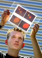 Entwicklung neuer diagnostischer Marker zur Differenzierung von Schilddrüsentumoren